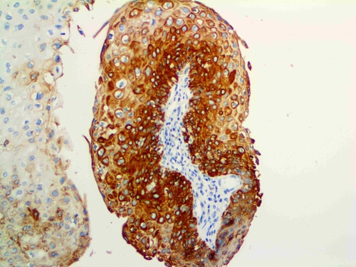 IHC of Cytokeratin 17 (CK17) on a FFPE Cervical Cancer Tissue